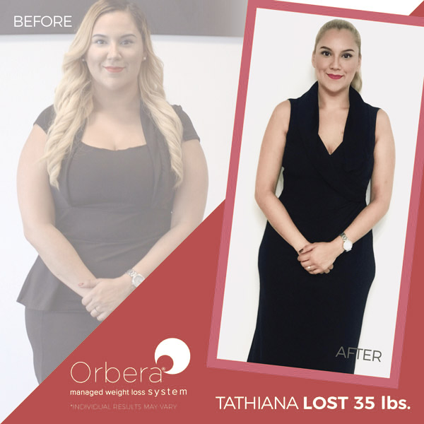 Tathiana before and after Orbera treatment | BETB