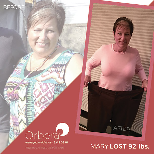 Mary before and after Orbera treatment | BETB