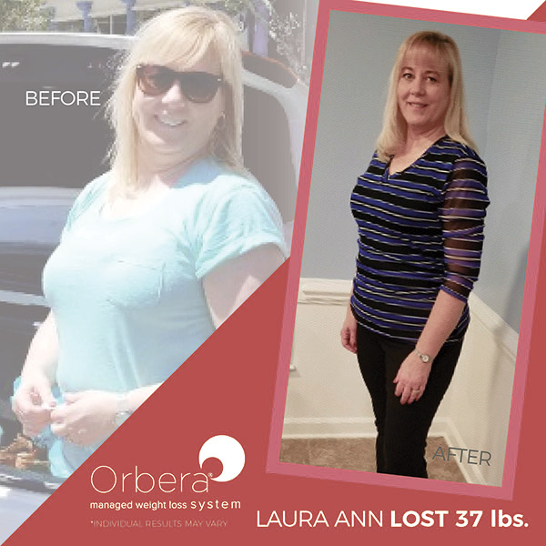 Laura before and after Orbera treatment | BETB